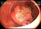 Adenocarcinoma de Ciego